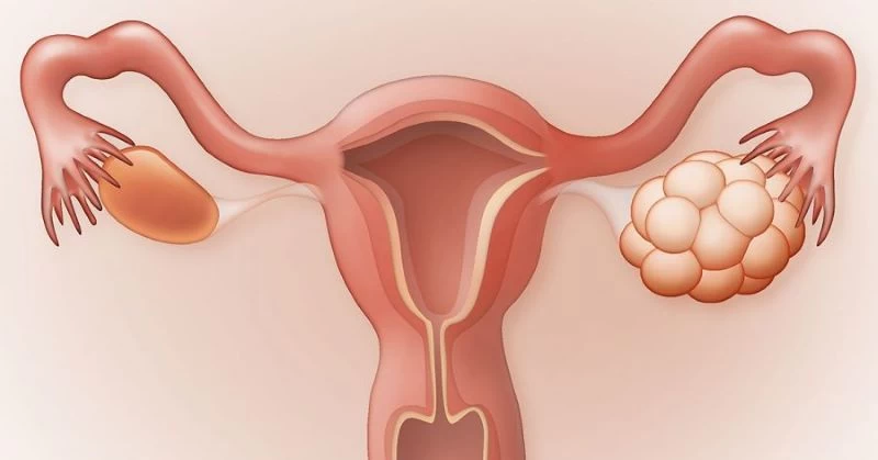 Bệnh PCOS có thể khiến nữ giới bị trễ kinh