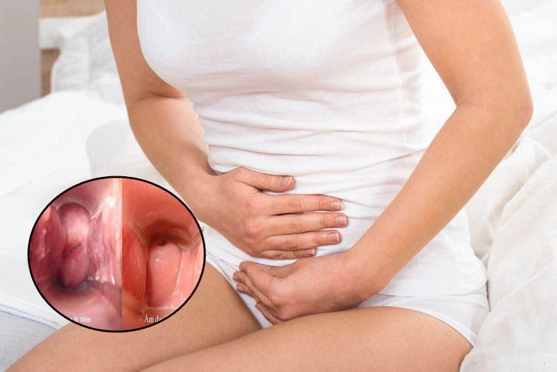Vùng kín tổn thương khi bị viêm nhiễm do quan hệ không dùng bao